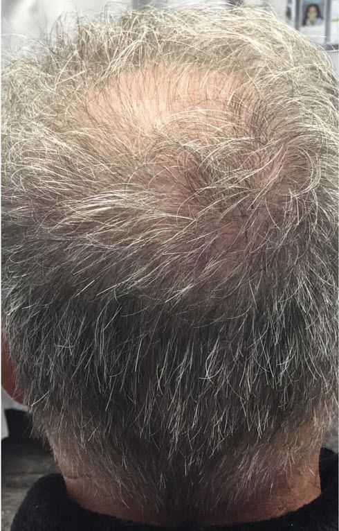 Platelet Rich Fibrin Hair Restoration & Treatments | Blades Wellness  Cypress, TX